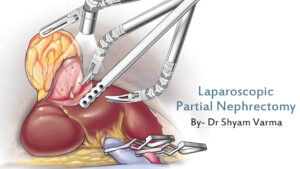 Laparoscopic Partial Nephrectomy