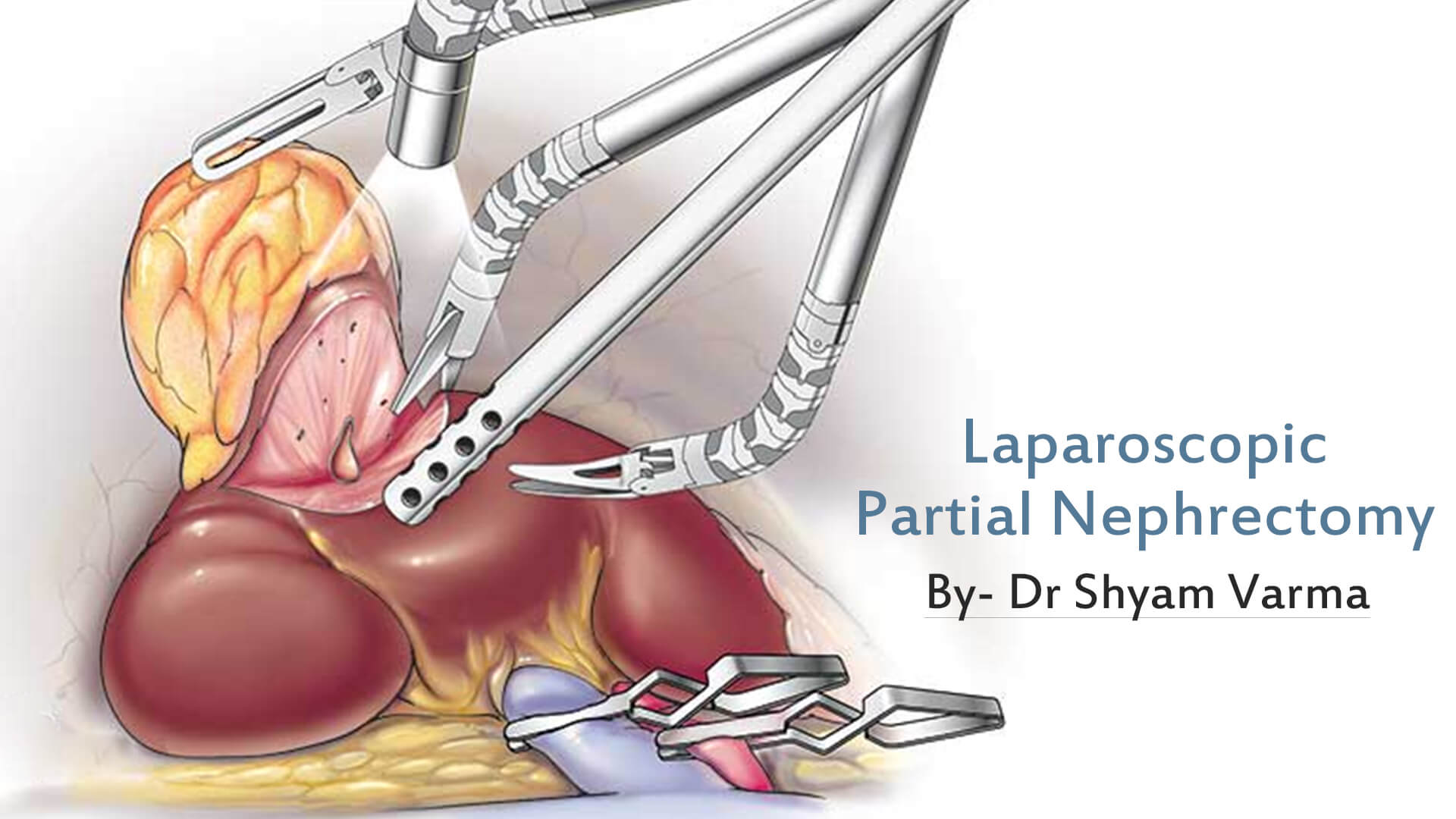 Laparoscopic Partial Nephrectomy