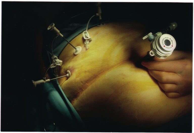 What is Laparoscopic Donor Nephrectomy?