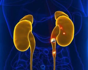 Everything You Need To Know About Kidney Stones