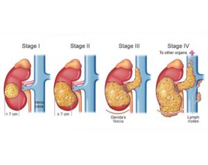Know about Kidney Cancer?