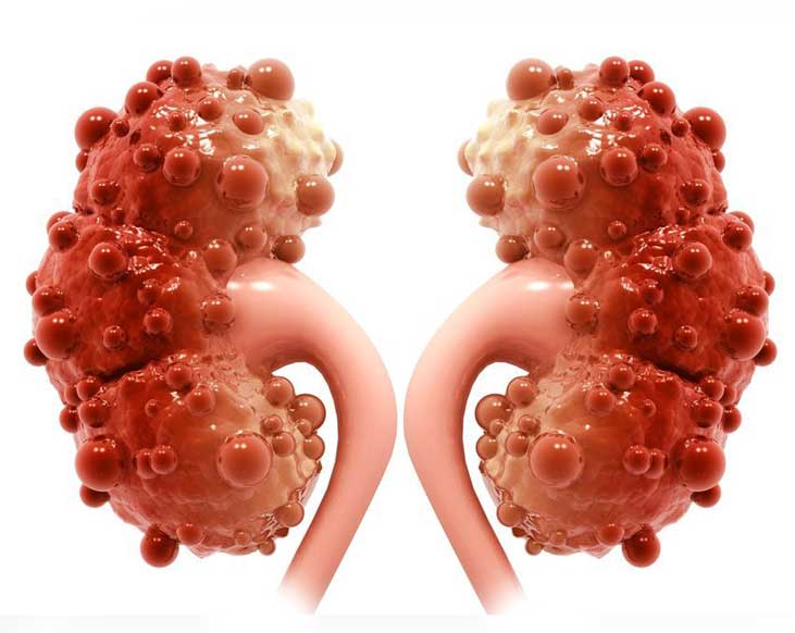 Living with Renal Cysts