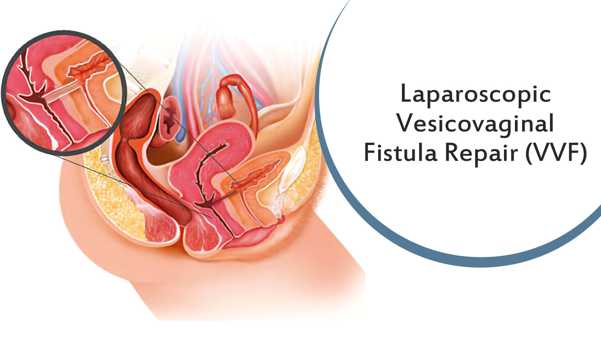 Laparoscopic Vesicovaginal Fistula Repair (VVF) – Vlog