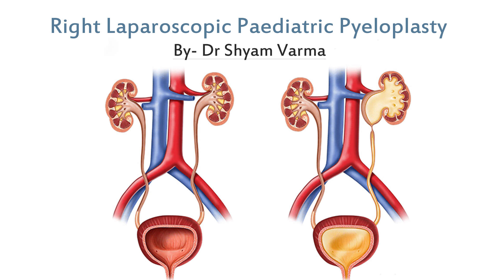 Right Laparoscopic Paediatric Pyeloplasty