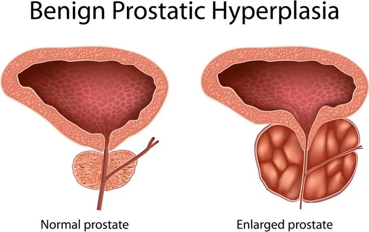PROSTATE ENLARGEMENT: FACTS AND MYTHS