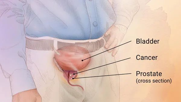 Prostate Cancer is most common cancer in men