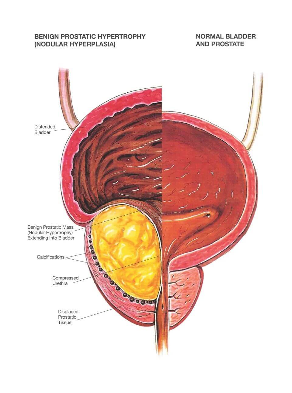 Laser Prostate Surgery (Holep)