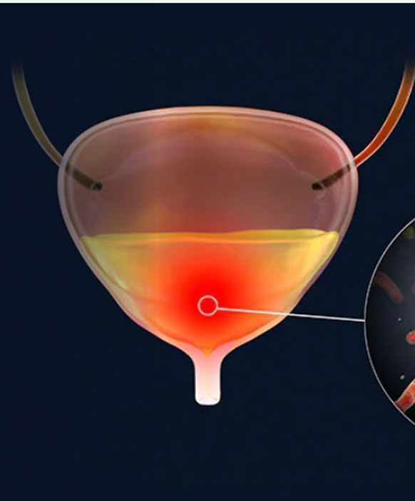 Recurrent UTIs In Women