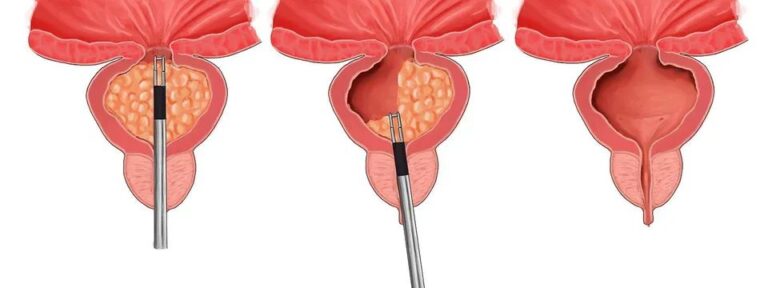 TURP (Transurethral resection of the prostate)