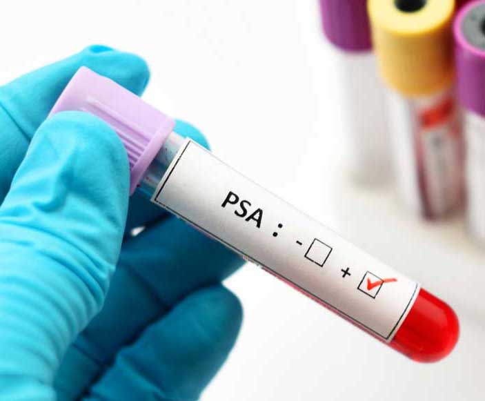 प्रोस्टेट कैंसर के लिए पी.एस.ए. परीक्षण: लाभ और हानि