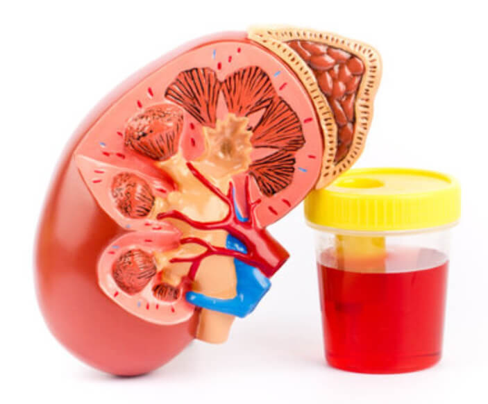 Blood in Urine: How serious is that a problem?