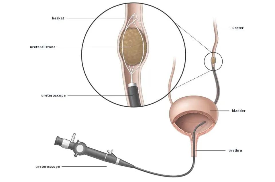 Ureteroscopic Surgery