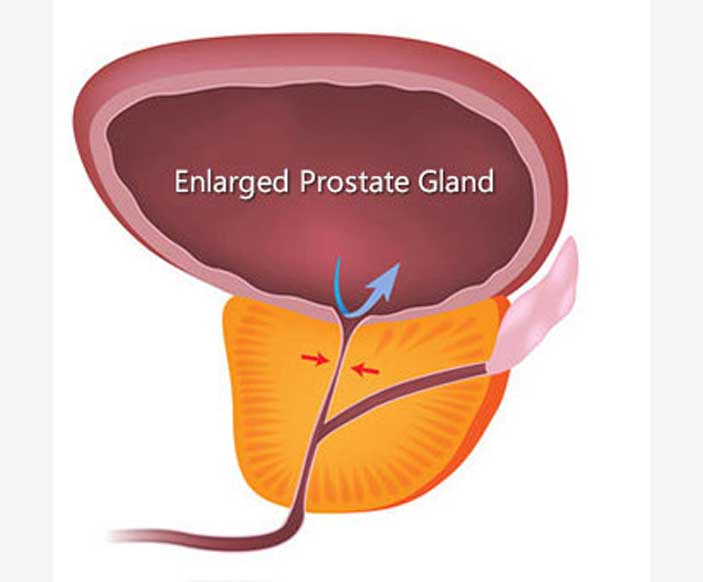 प्रोस्टेट की वृद्धि को रोकने के लिए 7 सलाह