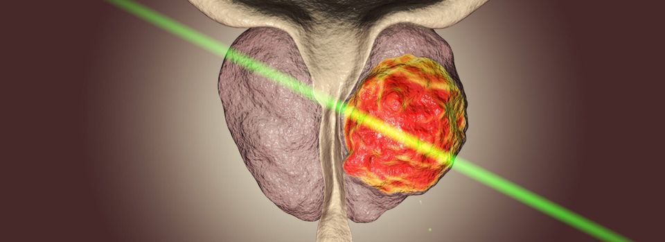 Laser Treatments in Urology