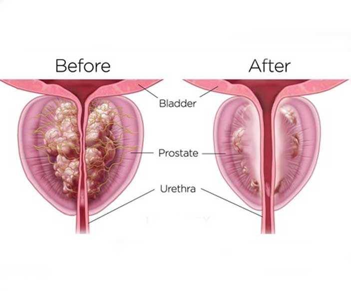प्रोस्टेट की वृद्धि के लिए चिकित्सा उपचार के कुछ फायदे और नुकसान