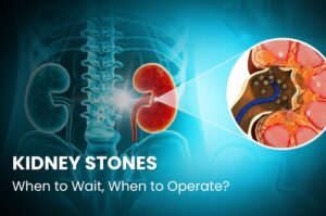 Kidney Stones: When to Wait and When to Operate?