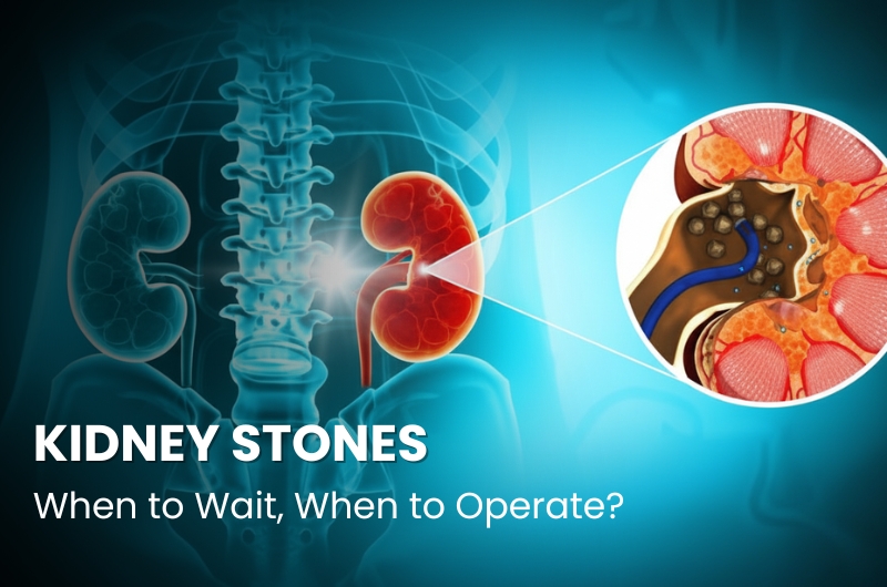 Kidney Stones: When to Wait and When to Operate?